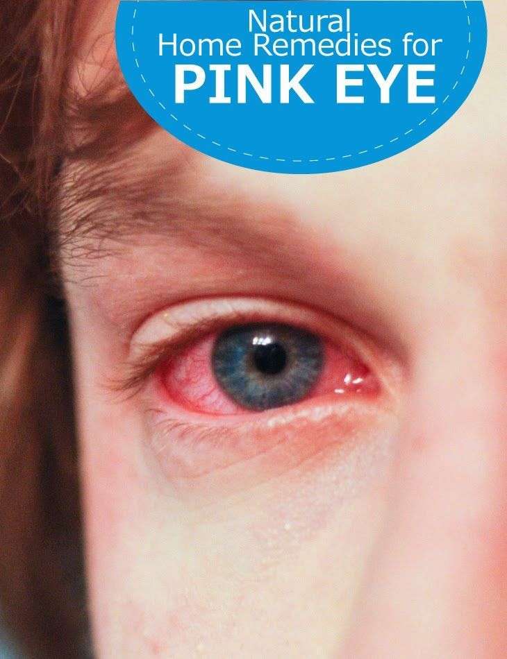 Natural Home Remedies for Pink Eye