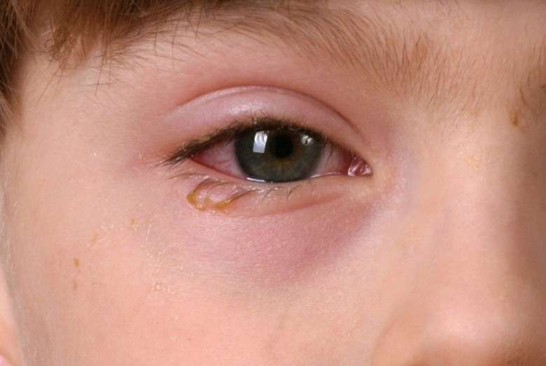 Natural Remedies for Eye Allergies