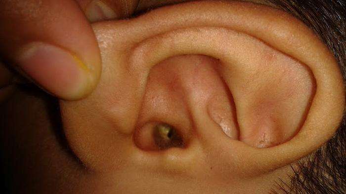 Natural Ways To Treat Ear Infection