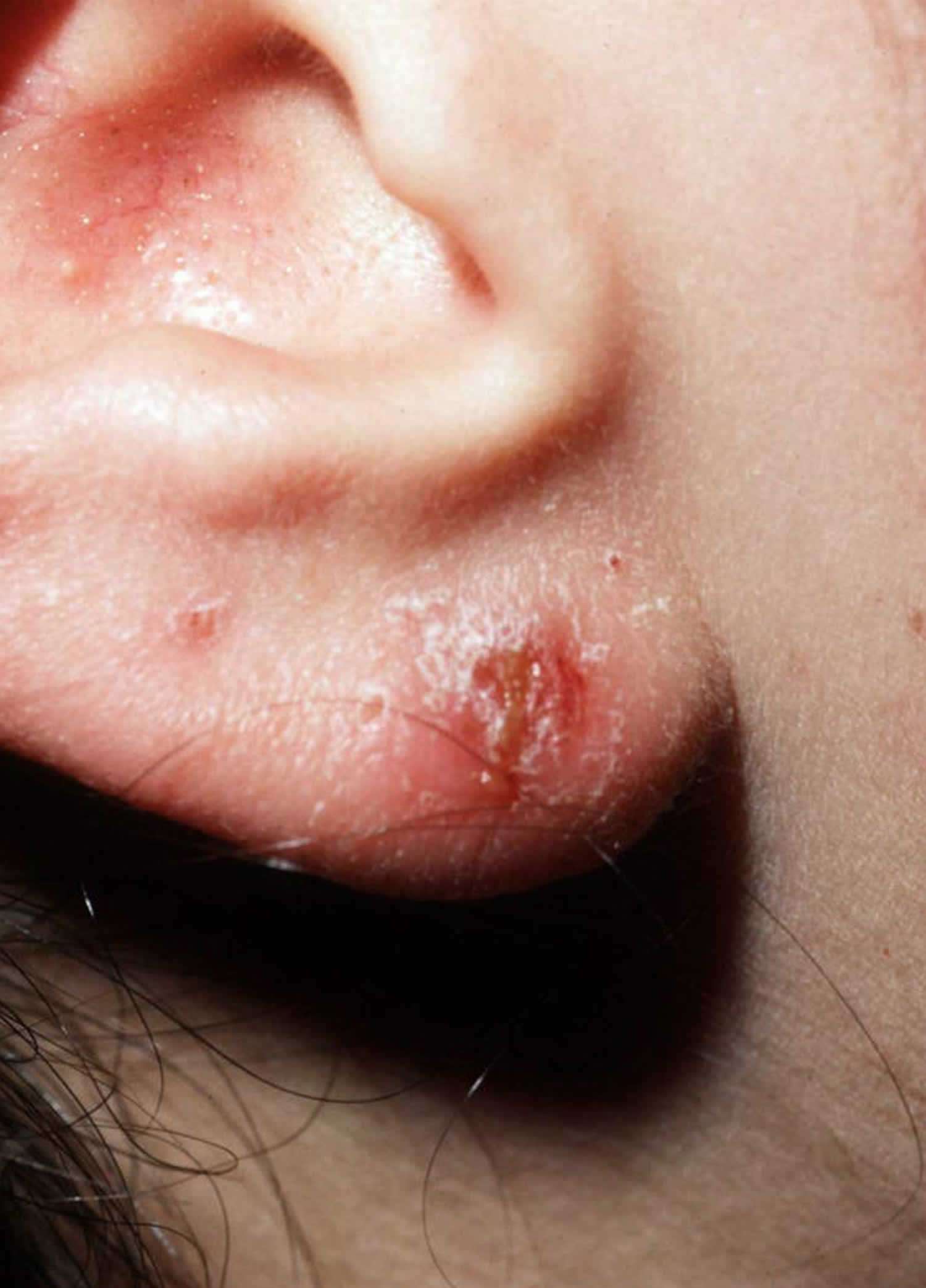 Nickel allergic contact dermatitis, causes, symptoms, diagnosis &  treatment