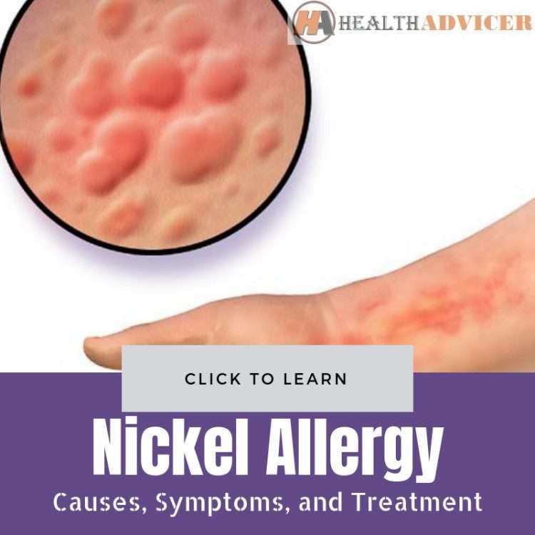 Nickel Allergy: Causes, Picture, Symptoms, and Treatment