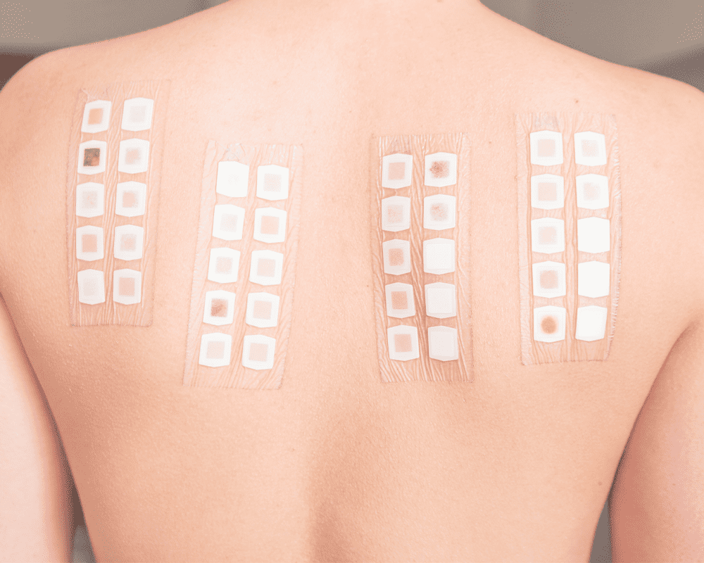 Patch Testing for Allergies