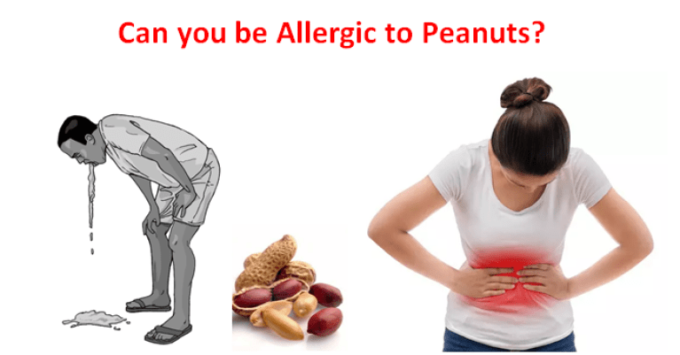 Peanut Allergy Symptoms, Treatment and Peanut Allergy ...