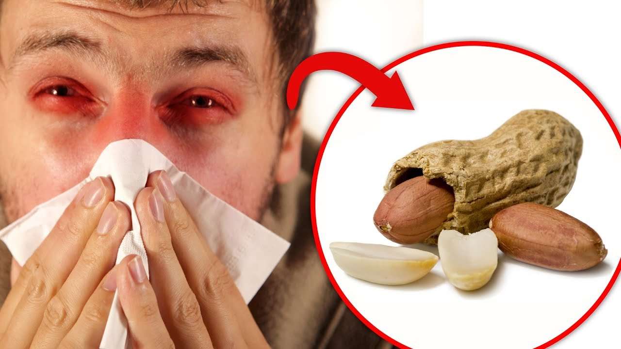 Peanut allergy treatment