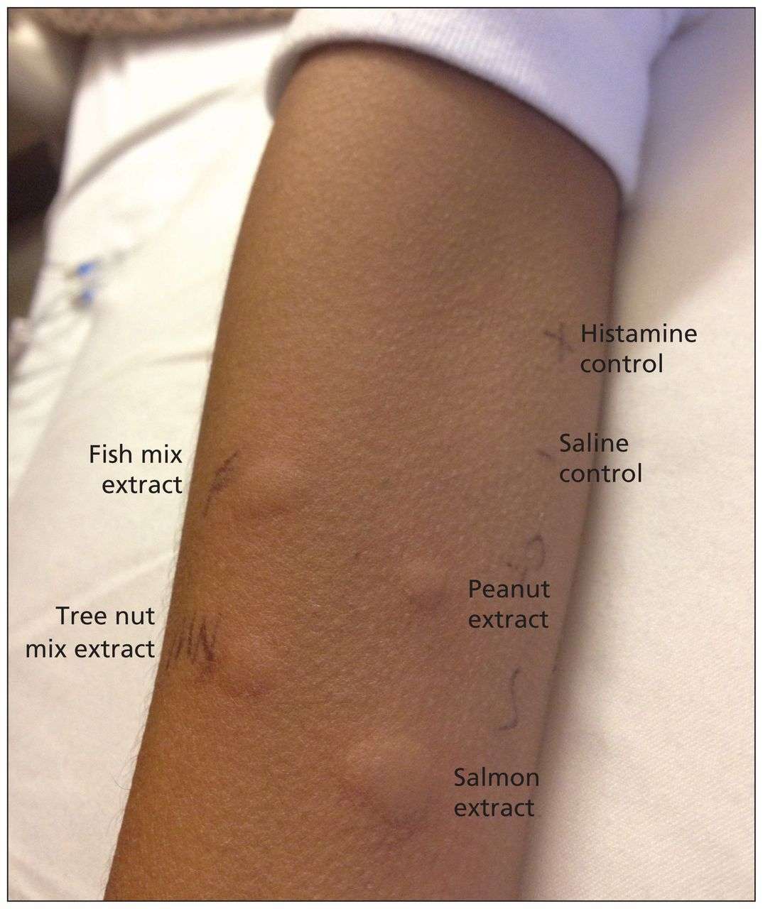 Peanut and fish allergy due to platelet transfusion in a child