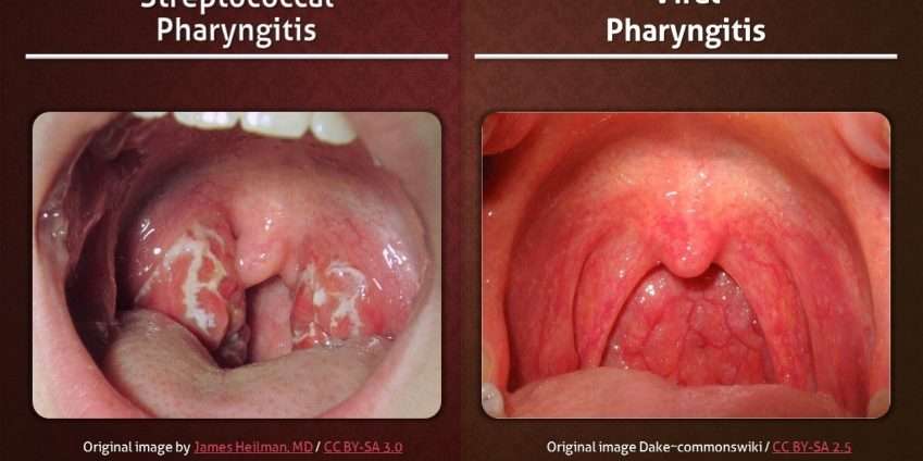Pharyngitis