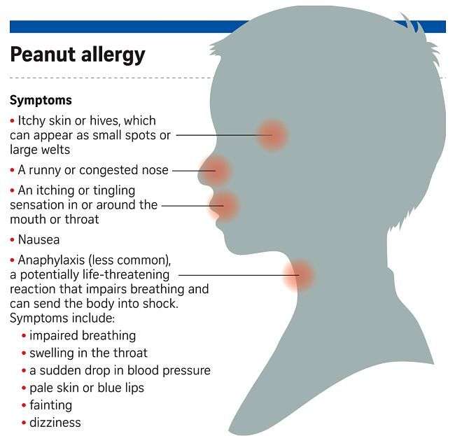 Pin on Allergies