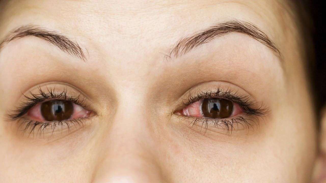 Pink eye and allergies have similar symptoms like itchy ...