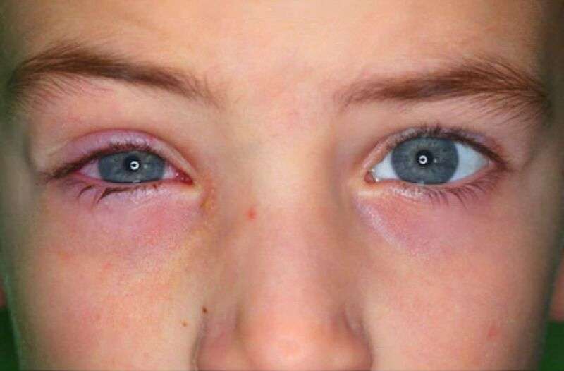 Pink Eye in Babies and Kids: Early Signs &  Pediatrician