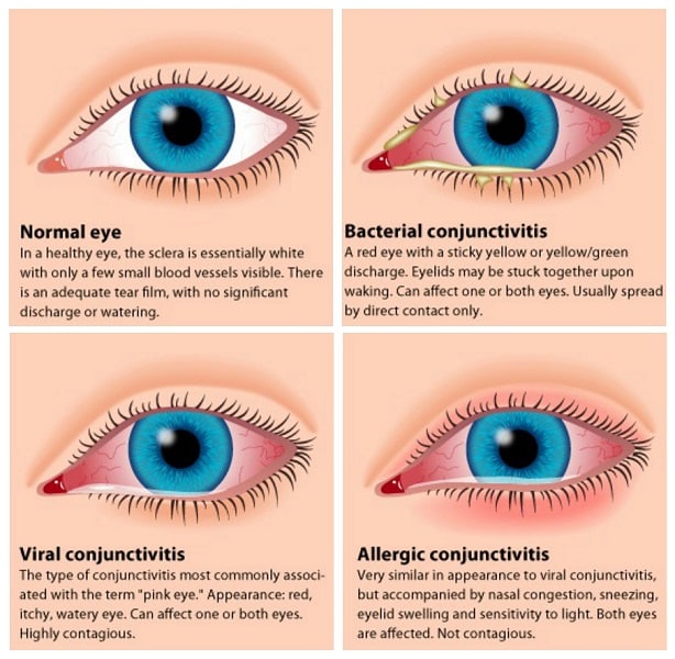 Pink Eye Treatment: 10 Proven Home Remedies For Conjunctivitis