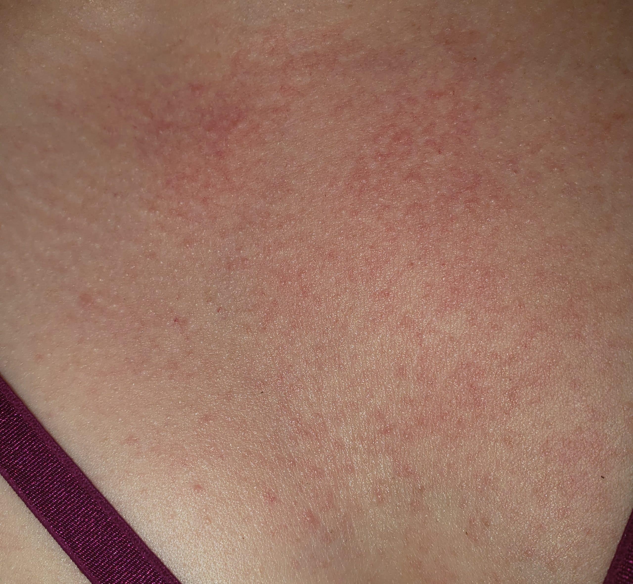 PMLE Sun Allergy Rash Pictures