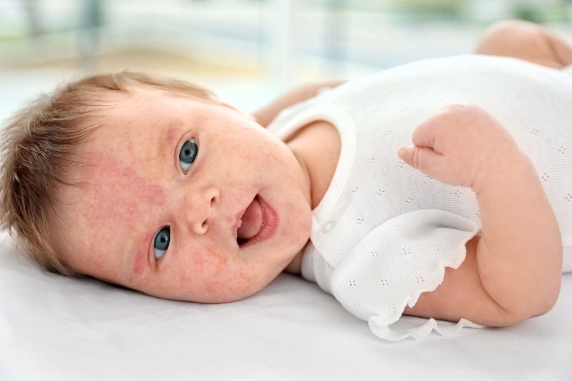 Recognizing Food Allergies In Babies: How to Identify ...