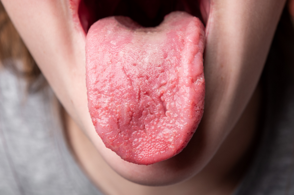 Red Spots on Tongue, Under, Back, Tip of Tongue