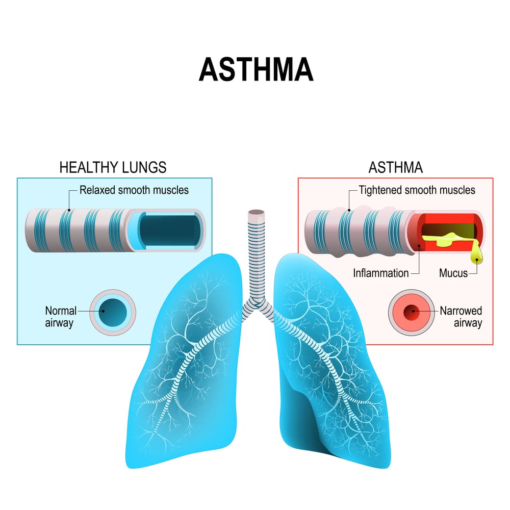 Relationship of Asthma and Allergies