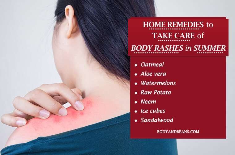 Remedies to Prevent and Cure Body Rashes and Prickly Heat ...