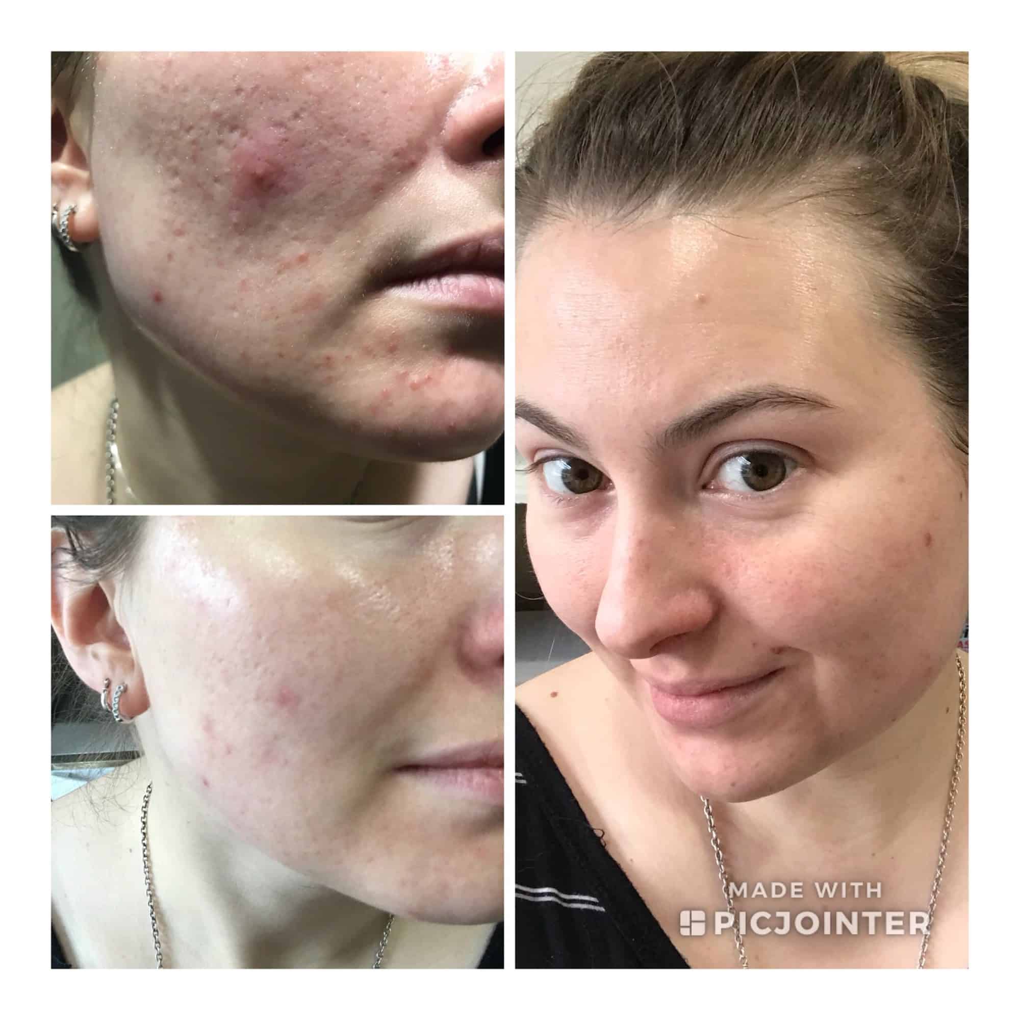 [routine help] Iâm going to be 30 and my skin is becoming worse ...