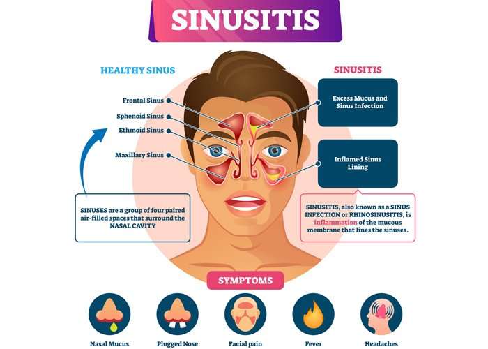 Sinusitis vs allergies
