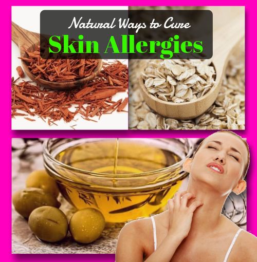Skin allergies home remedies: 10 Most Effective Ways to Overcome this ...