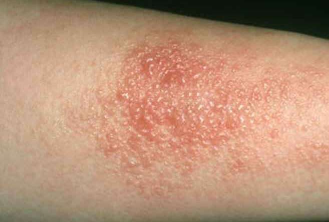 Skin Allergies To Pollen