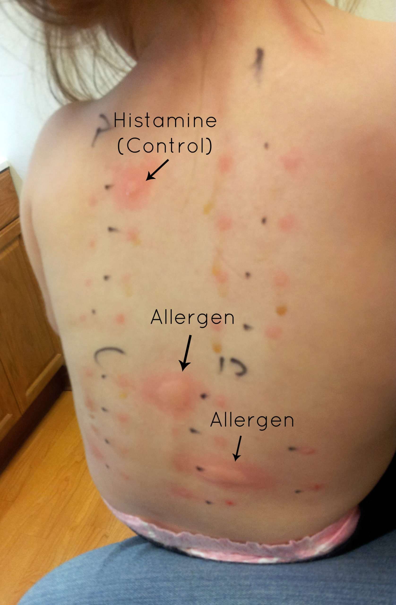Skin Allergy Test â Nutrition Mission