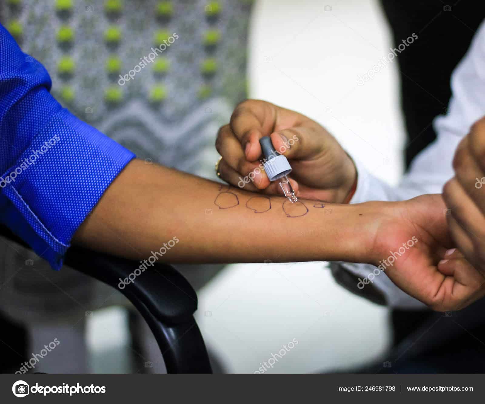 Skin Allergy Test Preparation Doctor Patient Hand Using Allergy ...