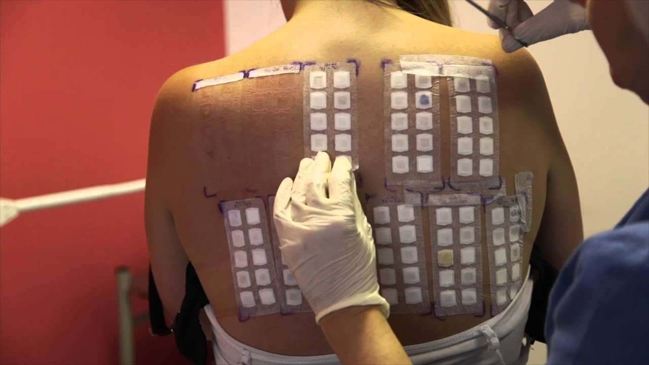 Skin Allergy Testing Using Patch Tests
