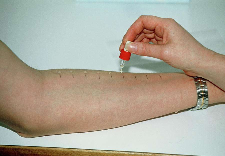 Skin Prick Allergy Test
