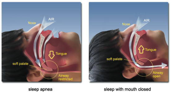 Snoring &  Disturbed Sleep in Children