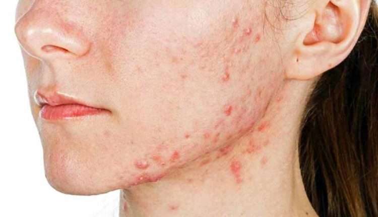 Some Tips About Foods That can Cause Skin Allergy