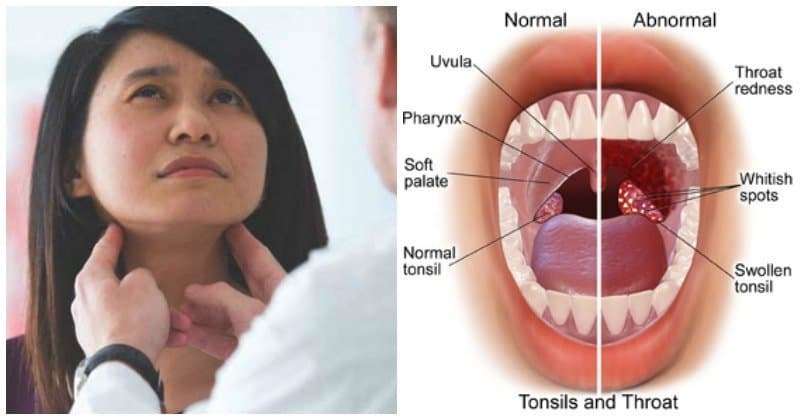 Sore Throat Remedies Cayenne Recipe Tonsillitis Patches ...