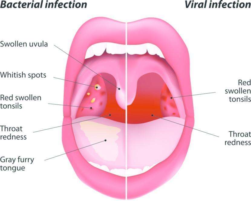 Sore Throat: Symptoms, Causes, Treatment, and Diagnosis ...