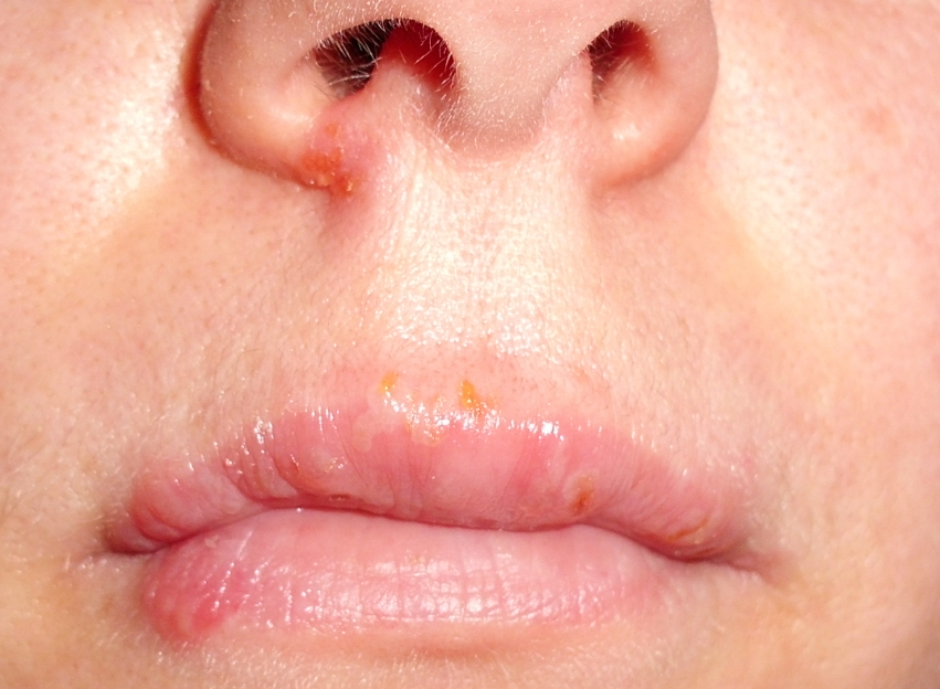 Sores in Nose, Around, Inside Nose Causes, Treatments ...