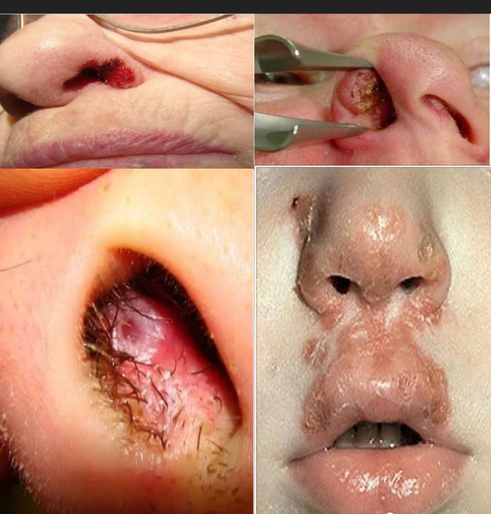 Sores in Nose: Causes, Treatment, Pictures