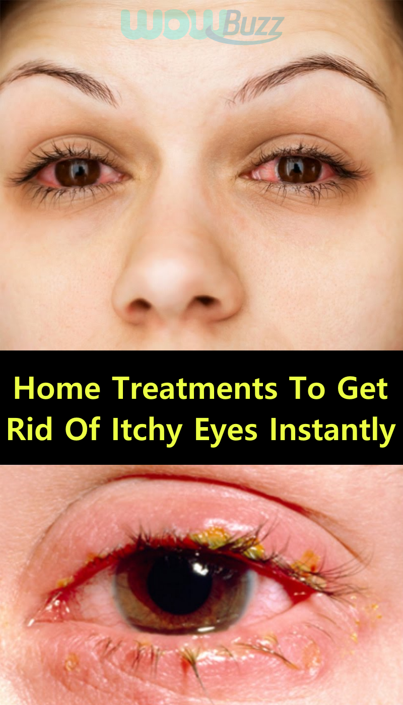 Stop Rubbing Your Eyes! Home Treatments To Get Rid Of Itchy Eyes ...