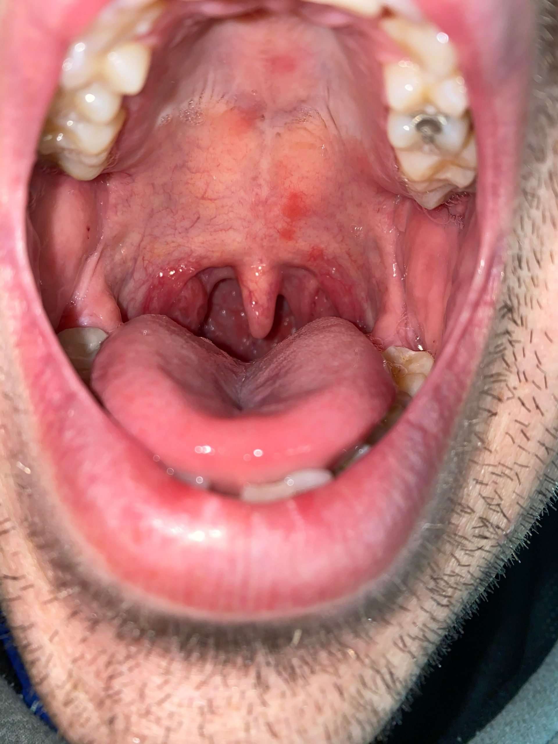 Strep throat or allergies? : ent