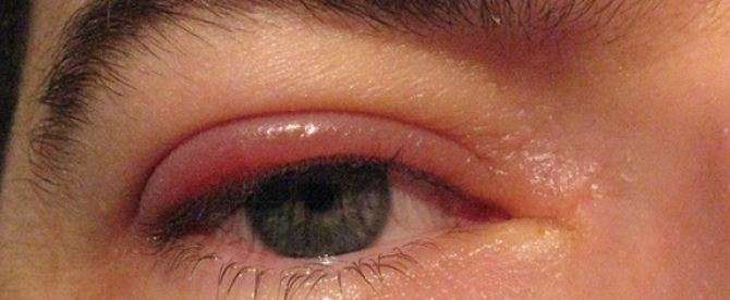 Swollen Eyelid, Causes, Pictures, Allergies, Stye, Eyelid ...
