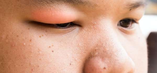 Swollen Eyelid Causes &  Treatment Options