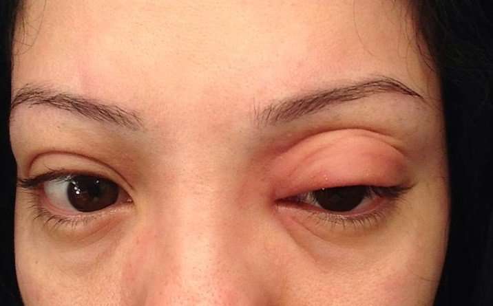 Swollen Eyes From Allergies Pictures