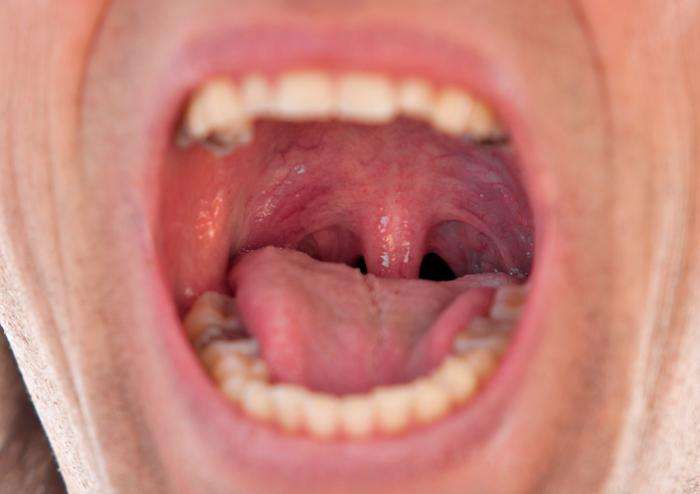 Swollen uvula: Causes, symptoms, and remedies