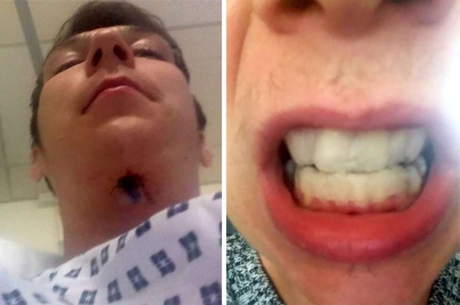 Teeth whitening kit left man with hole in throat after ...