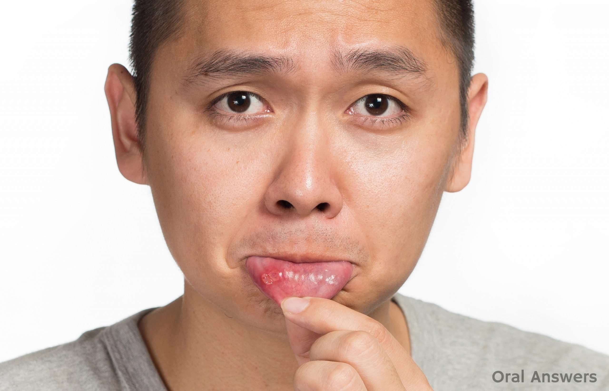 Ten Causes of Canker Sores