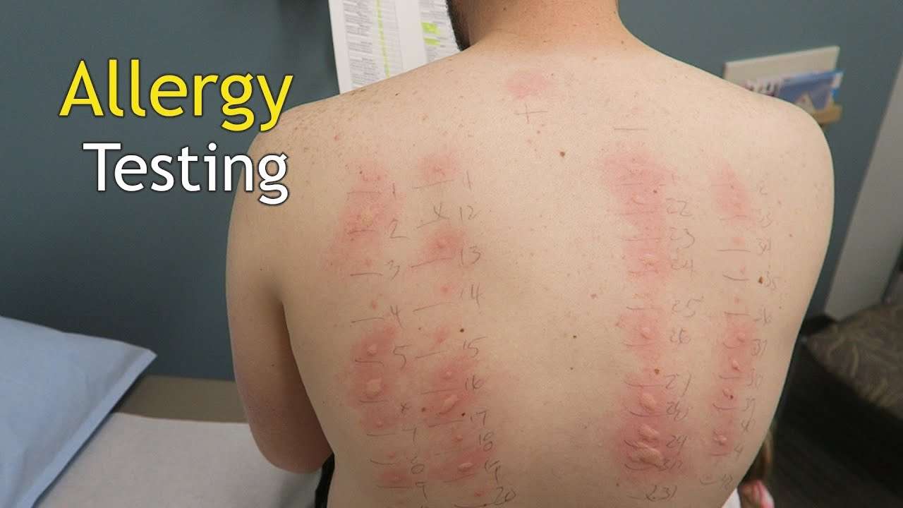 Ten Signs That You Need an Allergy Testing