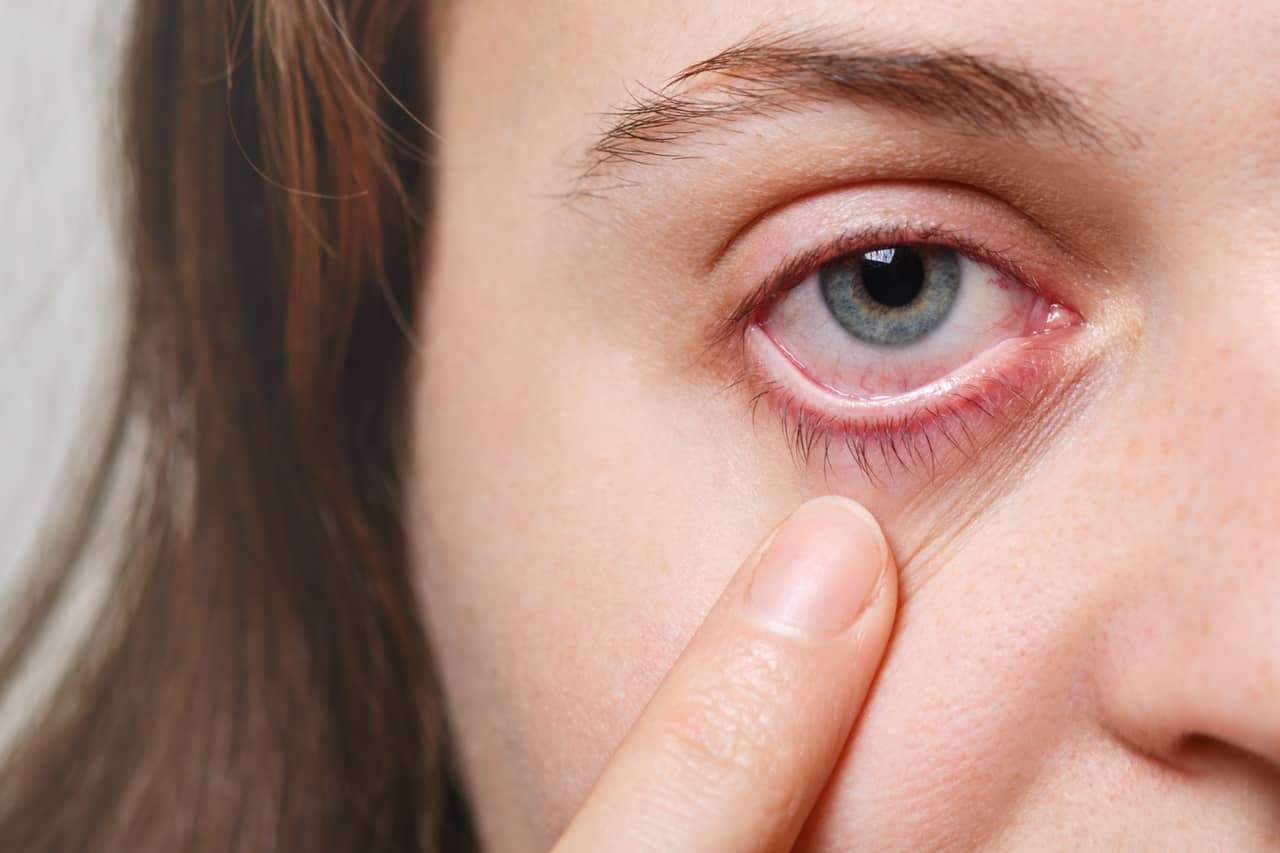 The Best Ways to Treat Eye Allergies
