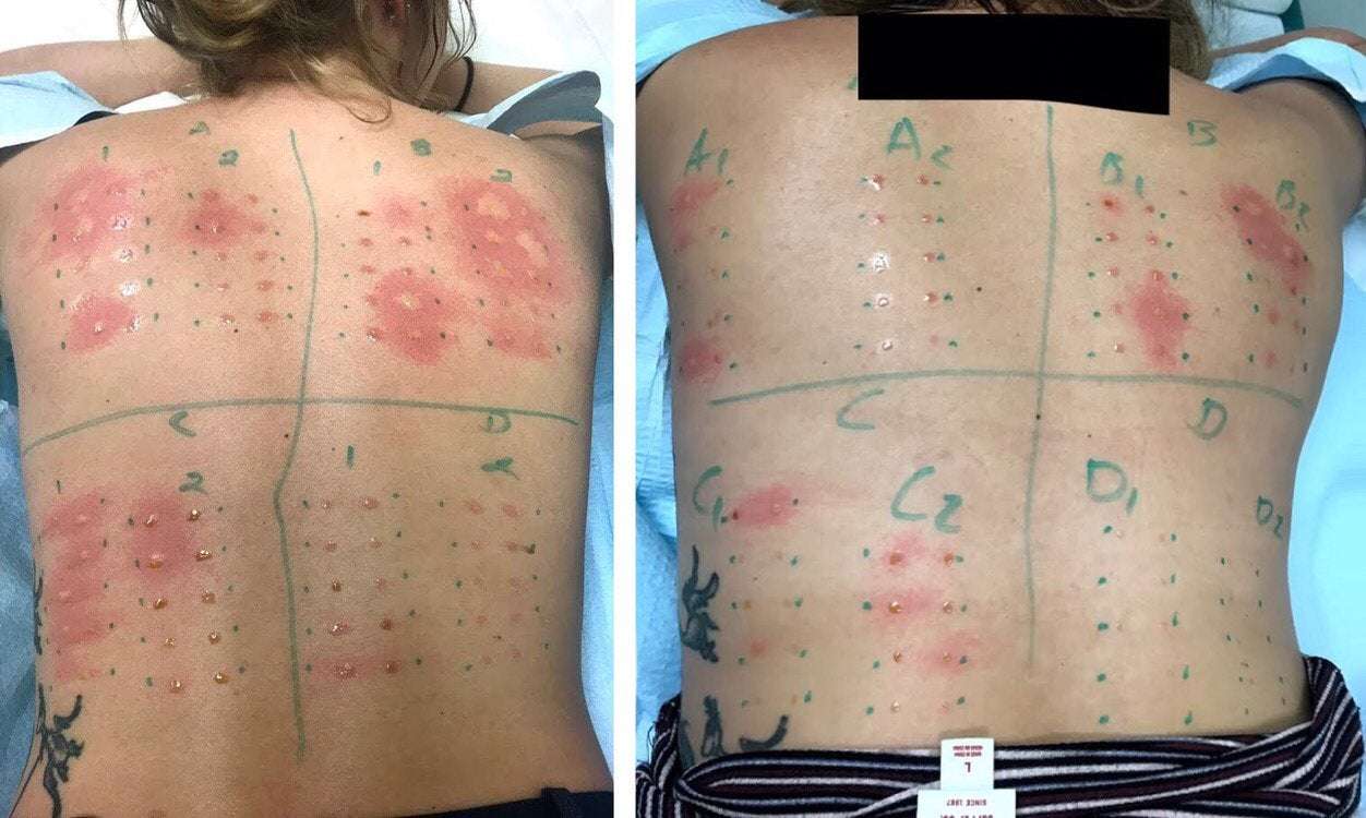 The difference that one year of allergy shots makes ...