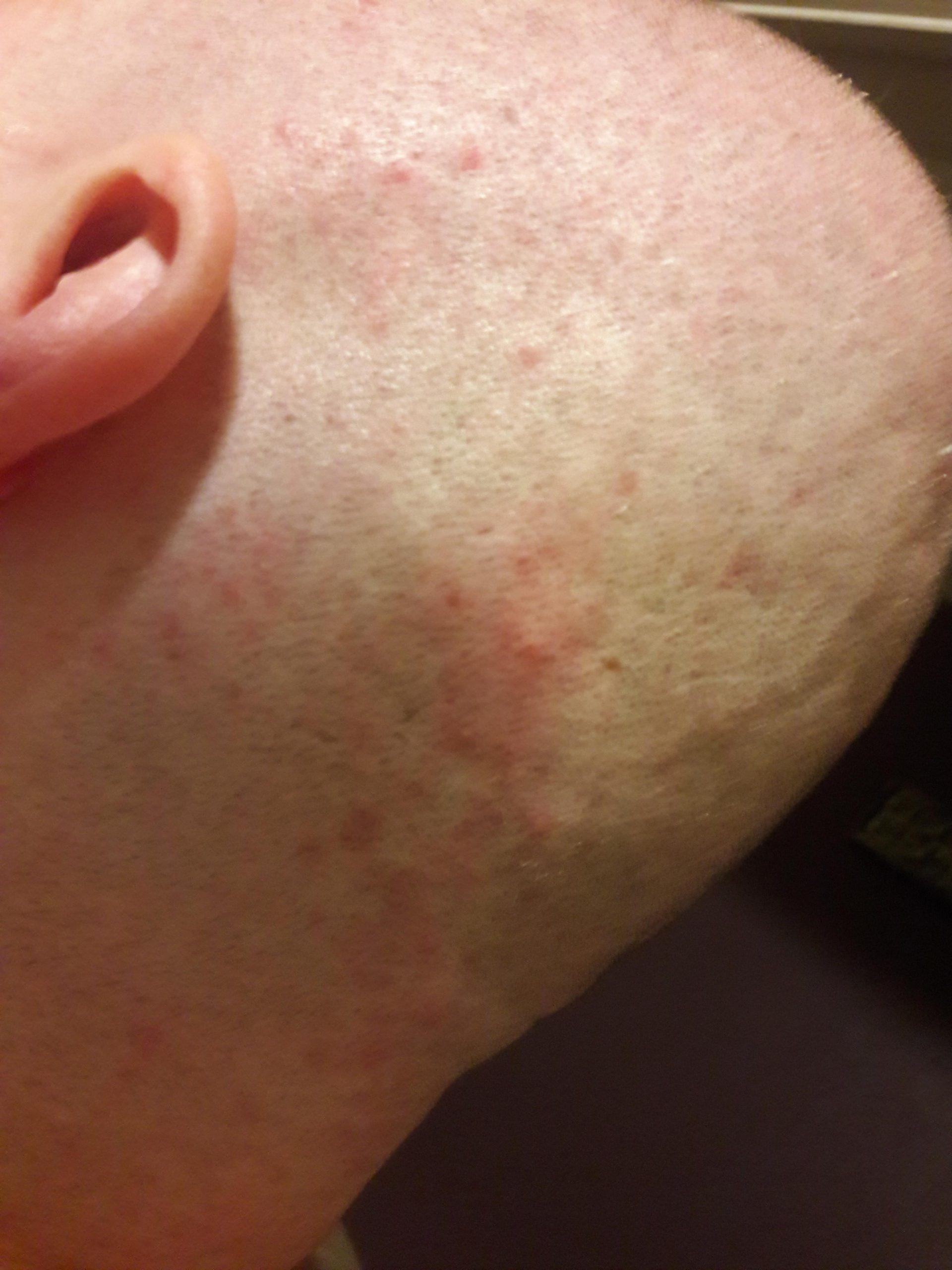 The rare side effect of abilify allergy: blistery rash ðâ¹ð¤¤ My husband ...