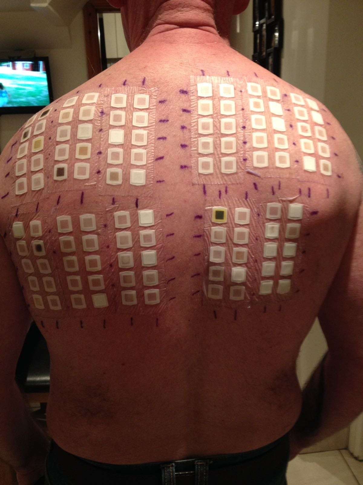 This is what an allergy test looks like : Damnthatsinteresting