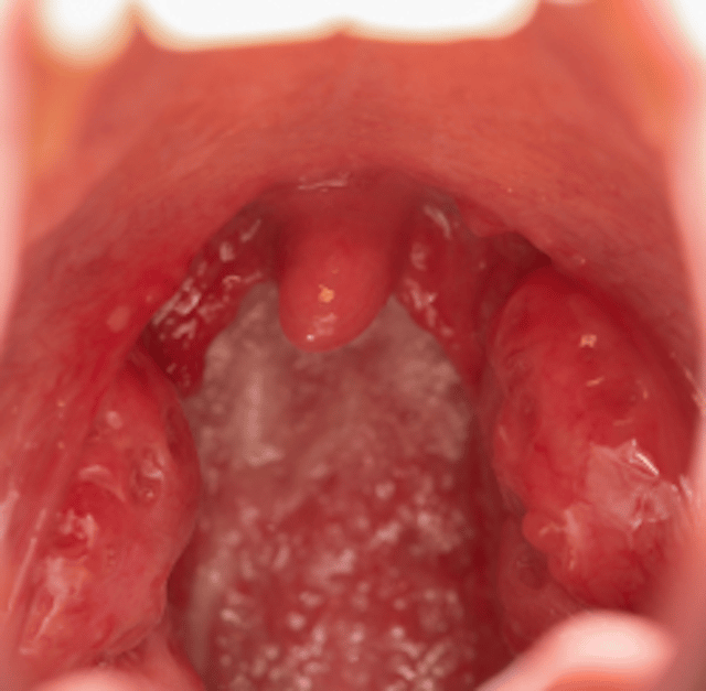 Tonsil stones: Symptoms, prevention, and treatment in the dental ...