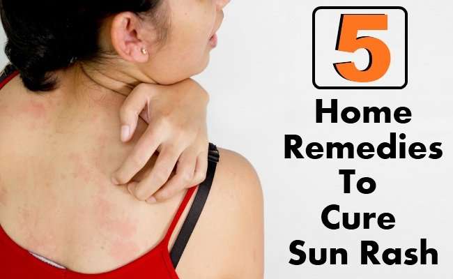 Top 5 Home Remedies To Cure Sun Rash