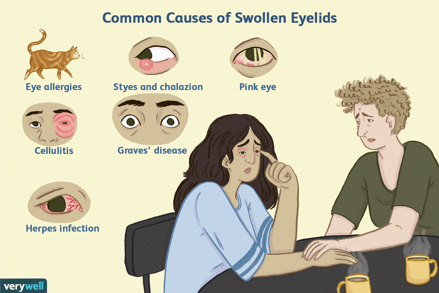 Top 6 Causes of Swollen Eyelids