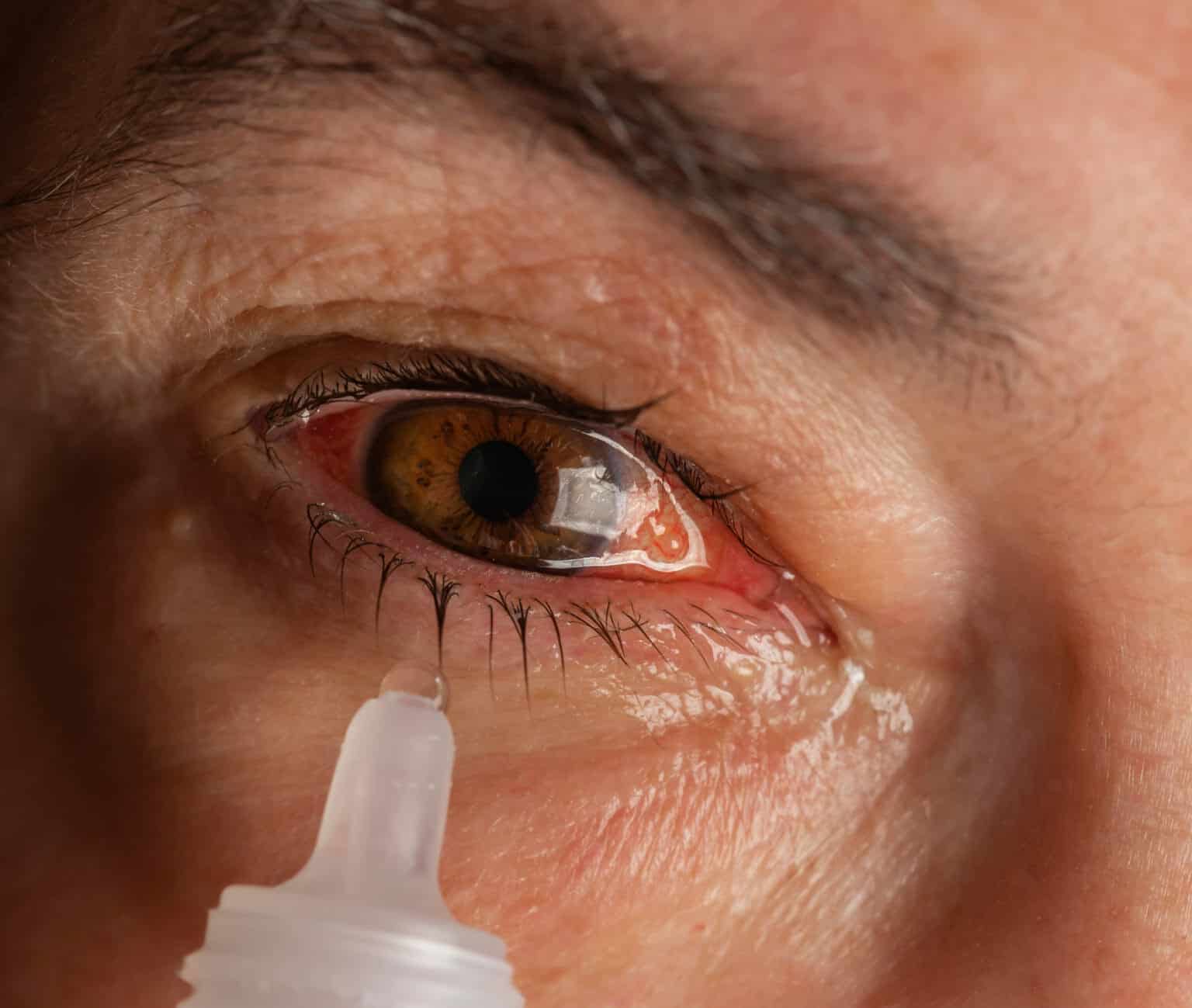 Topical Therapeutic Effective in Alleviating Allergic Conjunctivitis ...